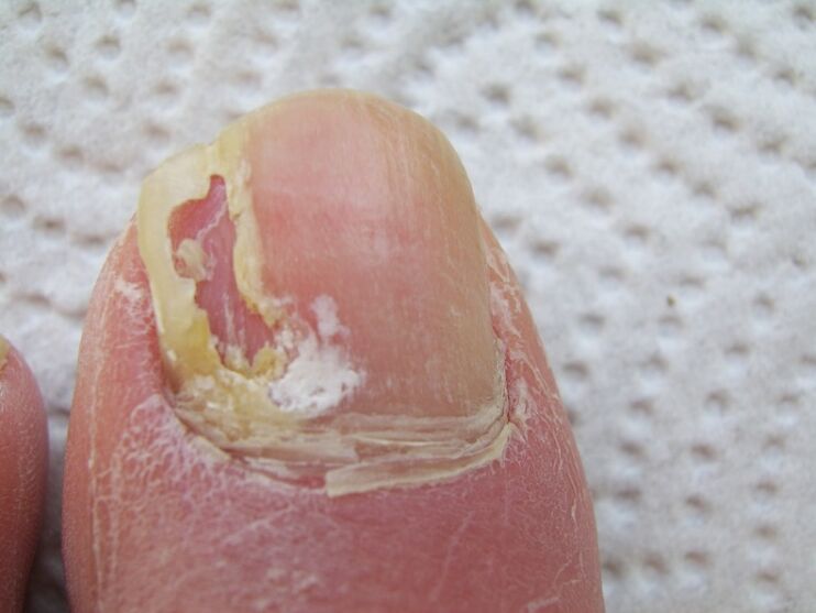 Onychomycosis esetén a körömlemez deformációja következik be